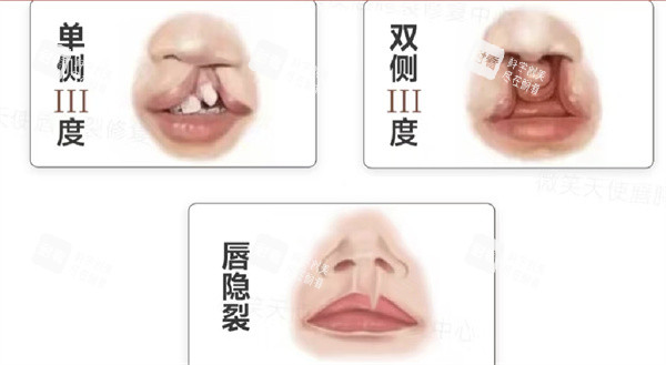 唇裂分型 唇裂分型