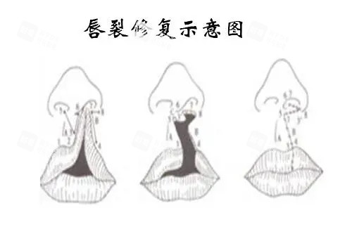 唇裂修复示意图.webp 唇裂修复示意图.webp