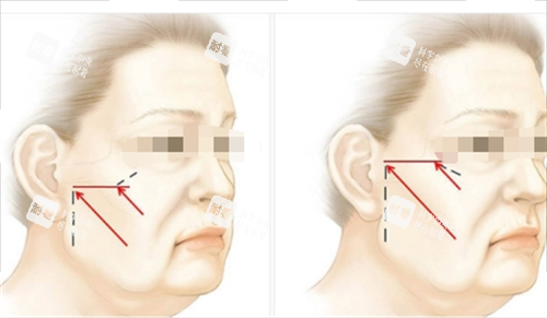 中上面部拉皮提拉方向画线图 中上面部拉皮提拉方向画线图