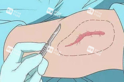 疤痕改善卡通图展示