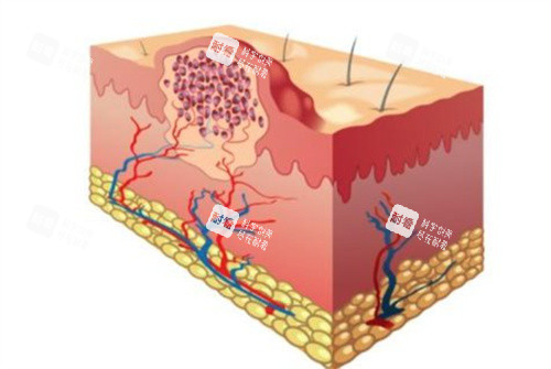 疤痕疙瘩 疤痕疙瘩