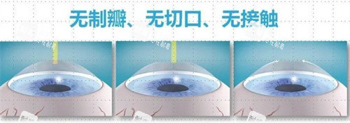 飞秒近视手术 飞秒近视手术