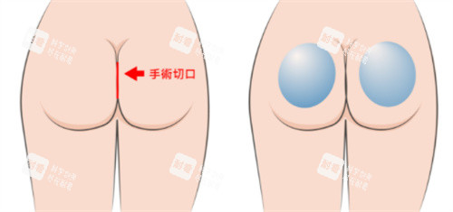 假体丰臀手术切口