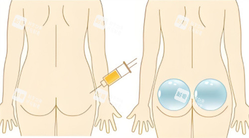 自体脂肪、假体丰臀对比