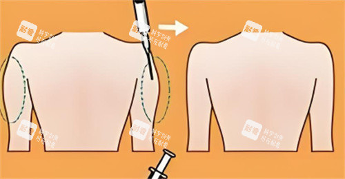 手臂吸脂前后对比