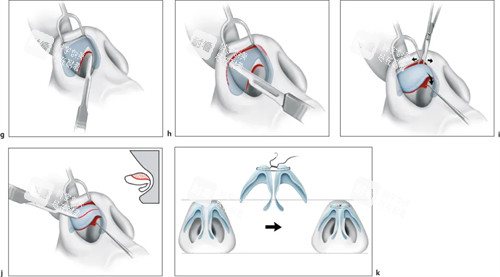 鼻头缩小手术过程图