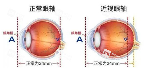 近视眼轴长度图片 近视眼轴长度图片