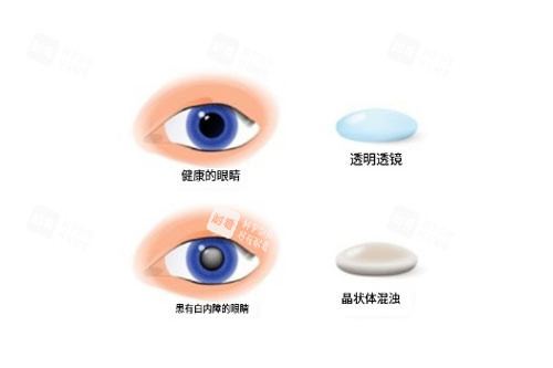 正常眼睛和白内障对比图
