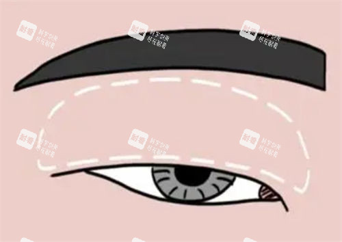 肿眼泡做双眼皮对比示意图