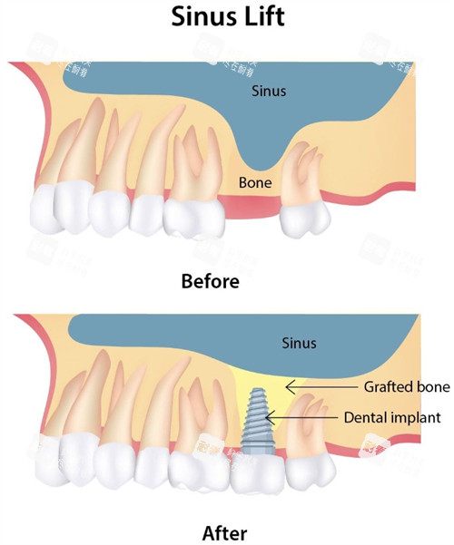 上颌窦提升前后对比