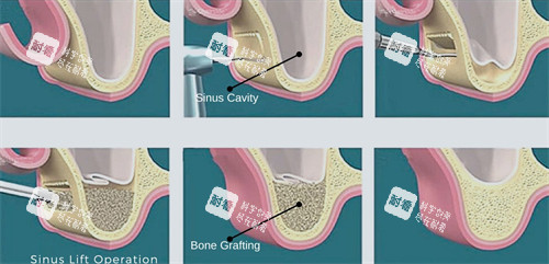 上颌窦提升手术过程