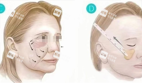 微拉美先提升流程图