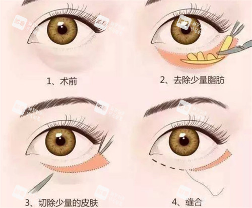 外切祛眼袋手术过程 外切祛眼袋手术过程