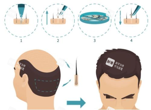 植发流程示意图