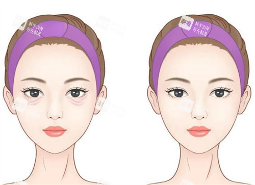 年轻祛眼袋前后对比