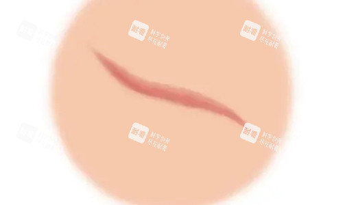 疤痕增生的不同动画展示图