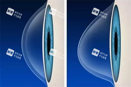 圆锥角膜角膜照片