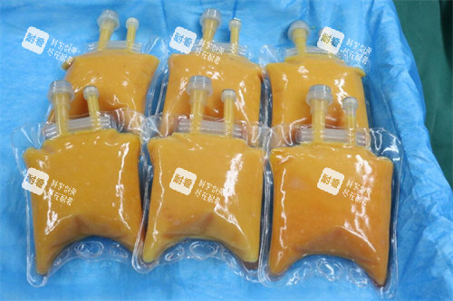 刘成胜脂肪丰胸材料展示