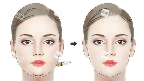 面部注射<span style=