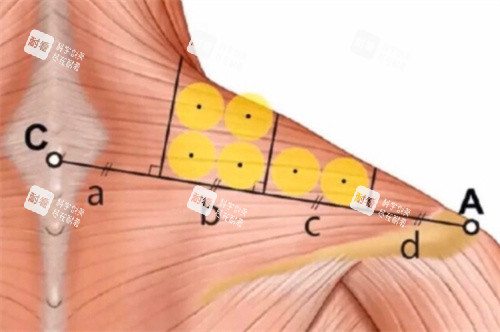 直角肩注射点位细节剖析