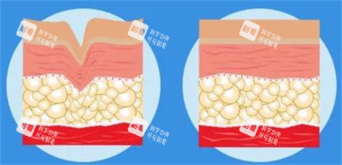 爱塑美童颜针注射前后对比图