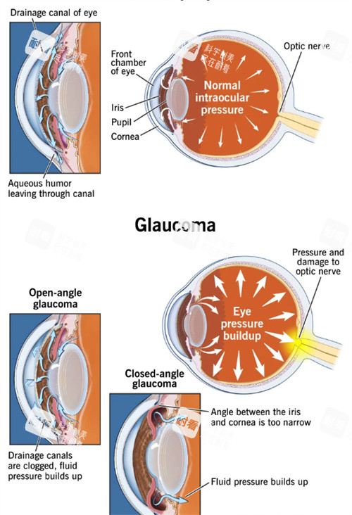青光眼和正常眼睛眼压不同