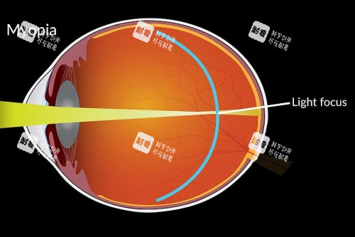 近视成像落在视网膜前