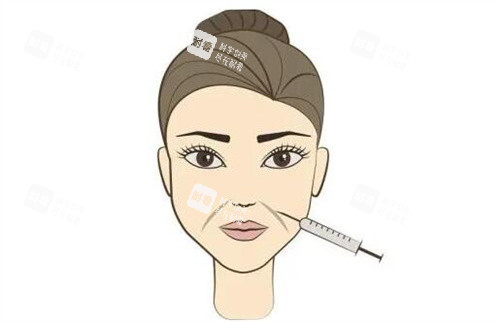 除皱针注射图