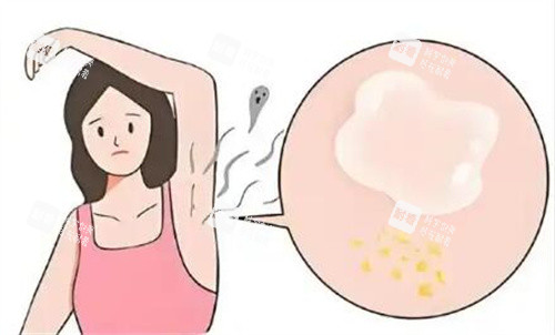 腋臭卡通图照片示意图