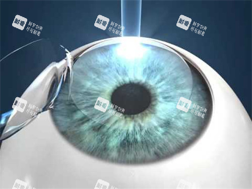 人工晶体植入眼睛图示