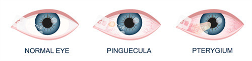 翼状胬肉的眼睛
