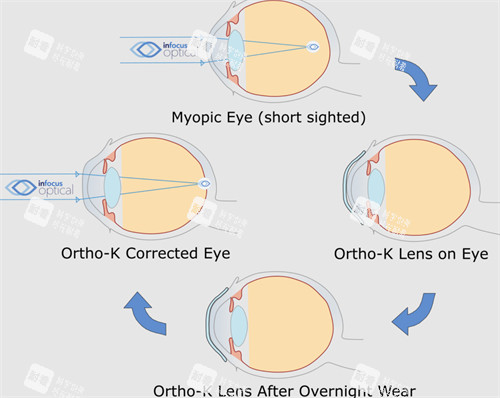 角膜塑形镜前后对比 角膜塑形镜前后对比