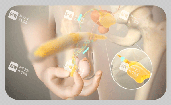 男性阴茎假体植入三件套手术过程