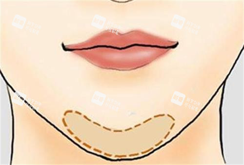 玻尿酸丰下巴的位置