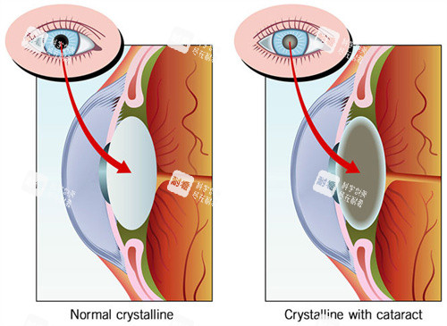 晶体置换手术前后对比