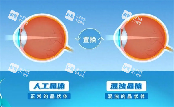 人工晶体置换示意图