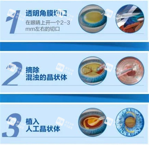 晶体置换手术图解