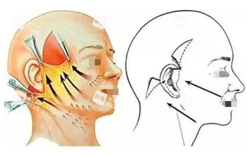 拉皮手术缝合前后示意图