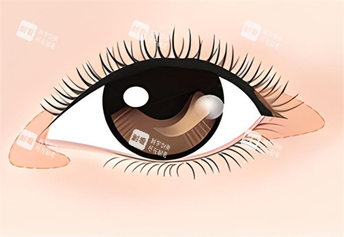 开眼角术宣传图