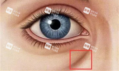 泪沟凹陷明显图