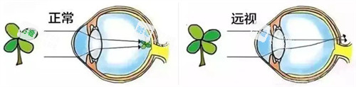 正常眼睛成像和远视眼睛成像 正常眼睛成像和远视眼睛成像