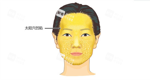 太阳穴凹陷演示动画图 太阳穴凹陷演示动画图