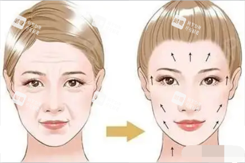 拉皮对比图 拉皮对比图