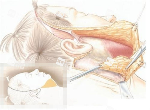 拉皮手术过程展示平面图 拉皮手术过程展示平面图