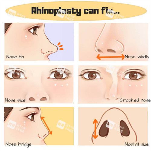 鼻修复流程一览图 鼻修复流程一览图