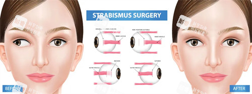 斜视手术原理图 斜视手术原理图