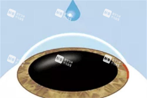 ICL晶体植入麻醉