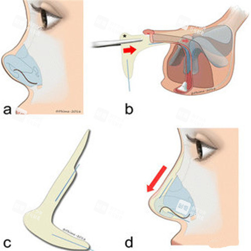 隆鼻过程图展示 隆鼻过程图展示