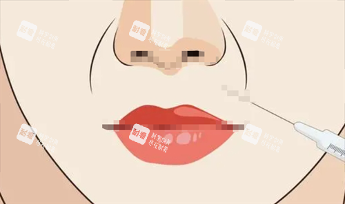 法令纹注射动画展示