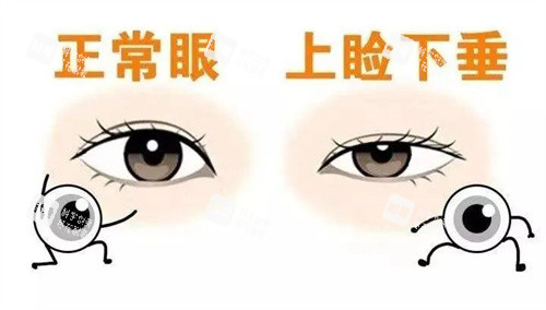 正常眼和上睑下垂 正常眼和上睑下垂